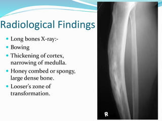 Radiological Findings
 Long bones X-ray:-
 Bowing
 Thickening of cortex,
narrowing of medulla.
 Honey combed or spongy,
large dense bone.
 Looser’s zone of
transformation.
 