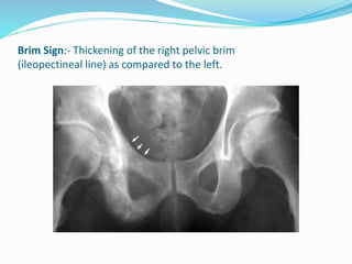 Brim Sign:- Thickening of the right pelvic brim
(ileopectineal line) as compared to the left.
 