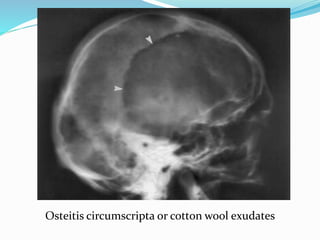 Osteitis circumscripta or cotton wool exudates
 