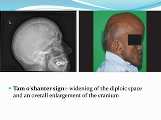  Tam o'shanter sign:- widening of the diploic space
and an overall enlargement of the cranium
 