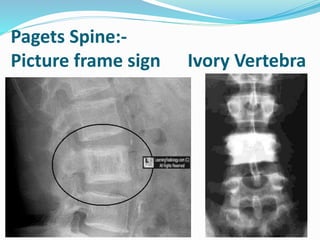 Pagets Spine:-
Picture frame sign Ivory Vertebra
 