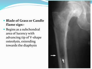  Blade of Grass or Candle
flame sign:-
 Begins as a subchondral
area of lucency with
advancing tip of V-shape
osteolysis, extending
towards the diaphysis
 