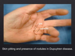 Skin pitting and presence of nodules in Dupuytren disease.
 