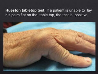 Hueston tabletop test: If a patient is unable to lay
his palm flat on the table top, the test is positive.
 