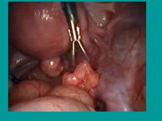 Miscarriage-and-Ectopic-Slides.powerpoint