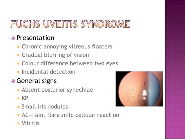 Posterior Uveitis Natural Treatment Posterior Uveitis Natural Treatment