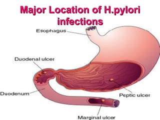 Major Location of H.pyloriMajor Location of H.pylori
infectionsinfections
 