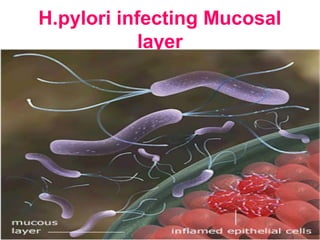 H.pylori infecting Mucosal
layer
 