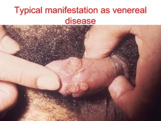 Typical manifestation as venereal
disease
 