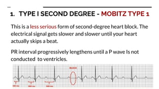 Types of heart blocks with it's ecg variations | PDF