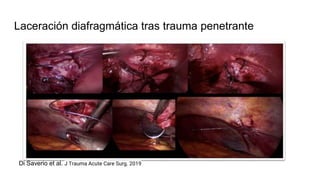 Laceración diafragmática tras trauma penetrante
Di Saverio et al. J Trauma Acute Care Surg. 2019
 