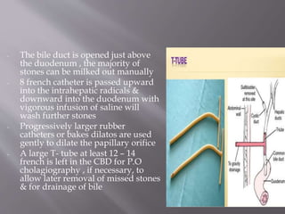 - The bile duct is opened just above
the duodenum , the majority of
stones can be milked out manually
- 8 french catheter is passed upward
into the intrahepatic radicals &
downward into the duodenum with
vigorous infusion of saline will
wash further stones
- Progressively larger rubber
catheters or bakes dilatos are used
gently to dilate the papillary orifice
- A large T- tube at least 12 – 14
french is left in the CBD for P.O
cholagiography , if necessary, to
allow later removal of missed stones
& for drainage of bile
 