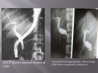 
ERCP shows missed stones at
CBD
Transtubal cholagiography shows large
CBD Stone completely obstruct it
 