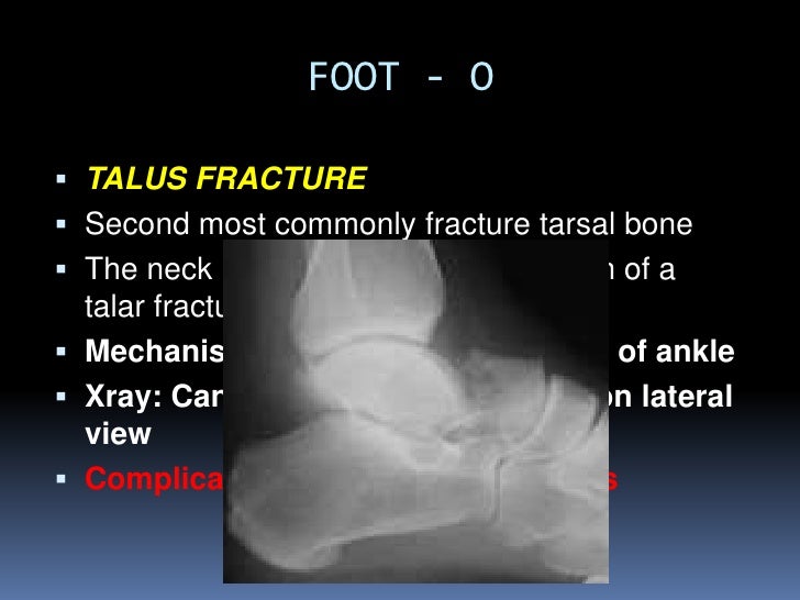 Missed fractures in Emergency Department