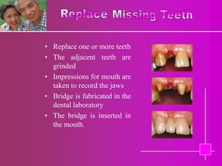 • Replace one or more teeth
• The adjacent teeth are
  grinded
• Impressions for mouth are
  taken to record the jaws
• Bridge is fabricated in the
  dental laboratory
• The bridge is inserted in
  the mouth.
 