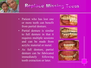 • Patient who has lost one
  or more teeth can benefit
  from partial denture.
• Partial denture is similar
  to full denture in that it
  requires multiple sessions
  and can be made from
  acrylic material or metal.
• As full denture, partial
  denture can be fabricated
  immediately      following
  tooth extraction or later.
 