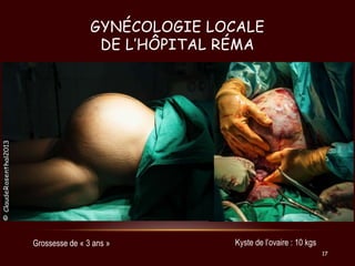 GYNÉCOLOGIE LOCALE
DE L’HÔPITAL RÉMA

Grossesse de « 3 ans »

Kyste de l’ovaire : 10 kgs
17

 