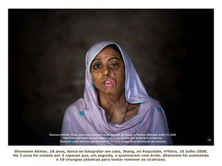 Shameem Akhter, 18 anos, deixa-se fotografar em casa, Jhang, no Paquistão, 4ªfeira, 10 Julho 2008.
Há 3 anos foi violada por 3 rapazes que, em seguida, a queimaram com ácido. Shameem foi submetida
a 10 cirurgias plásticas para tentar remover as cicatrizes.
 