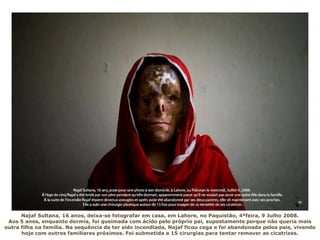 Najaf Sultana, 16 anos, deixa-se fotografar em casa, em Lahore, no Paquistão, 4ªfeira, 9 Julho 2008.
Aos 5 anos, enquanto dormia, foi queimada com ácido pelo próprio pai, supostamente porque não queria mais
outra filha na família. Na sequência de ter sido incendiada, Najaf ficou cega e foi abandonada pelos pais, vivendo
hoje com outros familiares próximos. Foi submetida a 15 cirurgias para tentar remover as cicatrizes.
 