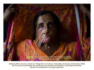 Shahnaz Bibi, 35 anos, deixa-se fotografar em Lahore, Paquistão, domingo, 26 Outubro 2008.
Há 10 anos foi queimada com ácido por um parente seu devido a uma disputa familiar.
Nunca foi submetida a cirurgias plásticas.
 