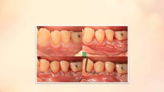 Minimally invasive surgical techniques in periodontics | PPTX