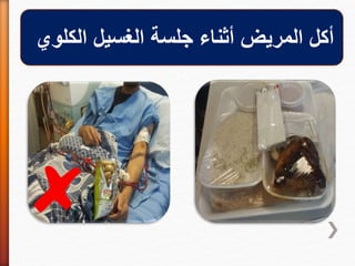 ‫الكلوي‬ ‫الغسيل‬ ‫جلسة‬ ‫أثناء‬ ‫المريض‬ ‫أكل‬
 