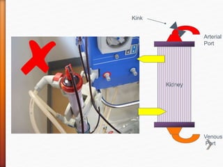 Kidney
Kink
Arterial
Port
Venous
Port
 