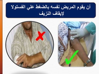 ‫يقوم‬ ‫أن‬‫المريض‬‫الفستوال‬ ‫علي‬ ‫بالضغط‬ ‫نفسه‬
‫النزيف‬ ‫إليقاف‬
 