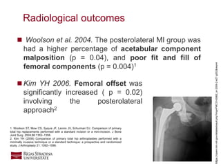 20
 Woolson et al. 2004. The posterolateral MI group was
had a higher percentage of acetabular component
malposition (p = 0.04), and poor fit and fill of
femoral components (p = 0.004)1
Radiological outcomes
1. Woolson ST, Mow CS, Syquia JF, Lannin JV, Schurman DJ. Comparison of primary
total hip replacements performed with a standard incision or a mini-incision. J Bone
Joint Surg. 2004;86:1353–1358.
2. Kim YH (2006) Comparison of primary total hip arthroplasties performed with a
minimally invasive technique or a standard technique: a prospective and randomized
study. J Arthroplasty 21: 1092–1098.
 Kim YH 2006. Femoral offset was
significantly increased ( p = 0.02)
involving the posterolateral
approach2
https://openi.nlm.nih.gov/detailedresult.php?img=PMC3143982_or-2009-2-e27-g002&req=4
 