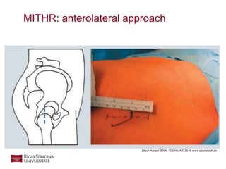 5
MITHR: anterolateral approach
Dtsch Arztebl 2006; 103(49):A3333–9 www.aerzteblatt.de
 
