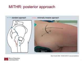 6
MITHR: posterior approach
Dtsch Arztebl 2006; 103(49):A3333–9 www.aerzteblatt.de
 