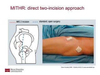 7
MITHR: direct two-incision approach
Dtsch Arztebl 2006; 103(49):A3333–9 www.aerzteblatt.de
 