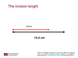 8
The incision lenght
Total hip arthroplasty through the mini-incision (Micro-hip) approach
versus the standard transgluteal (Bauer) approach: a prospective,
randomised study. J Orthop Surg (Hong Kong). 2014 Aug;22(2):168-72.
13,4 cm
9,3 cm
 