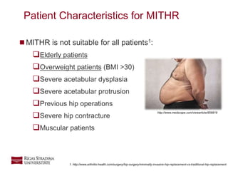 9
 MITHR is not suitable for all patients1:
Elderly patients
Overweight patients (BMI >30)
Severe acetabular dysplasia
Severe acetabular protrusion
Previous hip operations
Severe hip contracture
Muscular patients
Patient Characteristics for MITHR
1. http://www.arthritis-health.com/surgery/hip-surgery/minimally-invasive-hip-replacement-vs-traditional-hip-replacement
http://www.medscape.com/viewarticle/858818
 