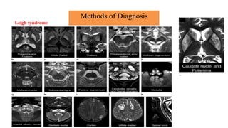 Methods of Diagnosis
Leigh syndrome
 
