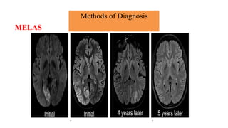 Methods of Diagnosis
MELAS
 