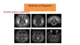 Methods of Diagnosis
Kearns-Sayre syndrome
 