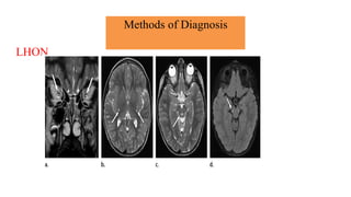 Methods of Diagnosis
LHON
 