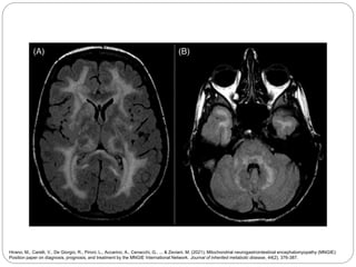Mitochondrial Neurogastrointestinal Encephalomyopathy (MNGIE).pptx