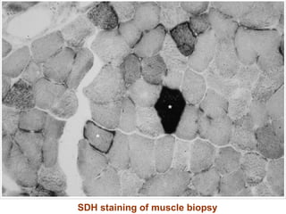 SDH staining of muscle biopsy 