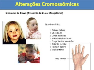 Síndrome de Down (Trissomia do 21 ou Mongolismo)
Quadro clínico
o Baixa estatura
o Obesidade
o Olhos oblíquos
o Mãos e dedos curtos
o Prega Simiesca na mão
o Retardo mental
o Homem estéril
o Mulher fértil
Alterações Cromossômicas
 