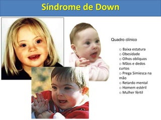 Quadro clínico
o Baixa estatura
o Obesidade
o Olhos oblíquos
o Mãos e dedos
curtos
o Prega Simiesca na
mão
o Retardo mental
o Homem estéril
o Mulher fértil
Síndrome de Down
 
