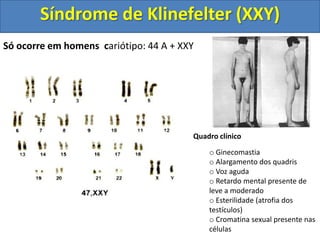 Só ocorre em homens cariótipo: 44 A + XXY
Quadro clínico
o Ginecomastia
o Alargamento dos quadris
o Voz aguda
o Retardo mental presente de
leve a moderado
o Esterilidade (atrofia dos
testículos)
o Cromatina sexual presente nas
células
Síndrome de Klinefelter (XXY)
 