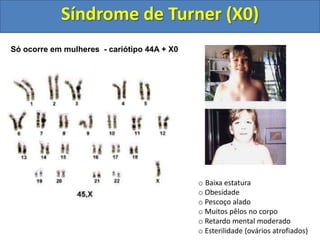 o Baixa estatura
o Obesidade
o Pescoço alado
o Muitos pêlos no corpo
o Retardo mental moderado
o Esterilidade (ovários atrofiados)
Síndrome de Turner (X0)
Só ocorre em mulheres - cariótipo 44A + X0
 