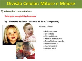 3) Alterações cromossômicas
Principais aneuploidias humanas
a) Síndrome de Down (Trissomia do 21 ou Mongolismo)
Quadro clínico
o Baixa estatura
o Obesidade
o Olhos oblíquos
o Mãos e dedos curtos
o Prega Simiesca na mão
o Retardo mental
o Homem estéril
o Mulher fértil
Divisão Celular: Mitose e Meiose
 