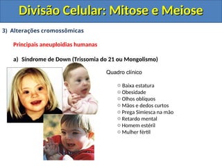 3) Alterações cromossômicas
Principais aneuploidias humanas
a) Síndrome de Down (Trissomia do 21 ou Mongolismo)
Quadro clínico
o Baixa estatura
o Obesidade
o Olhos oblíquos
o Mãos e dedos curtos
o Prega Simiesca na mão
o Retardo mental
o Homem estéril
o Mulher fértil
Divisão Celular: Mitose e Meiose
Divisão Celular: Mitose e Meiose
 