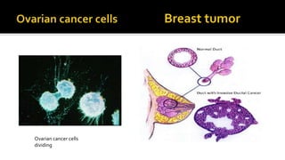 Ovarian cancer cells
dividing

 