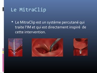 Le MitraClip 
 Le MitraClip est un système percutané qui 
traite l’IM et qui est directement inspiré de 
cette intervention. 
 