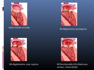 Valve mitrale normale 
IM dégénérative (prolapsus) 
IM dégénérative avec rupture IM fonctionnelle (VG dilaté avec 
anneau mitral dilaté) 
 