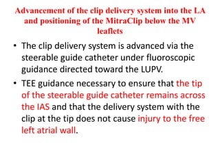 Advancement of the clip delivery system into the LA
and positioning of the MitraClip below the MV
leaflets
• The clip delivery system is advanced via the
steerable guide catheter under fluoroscopic
guidance directed toward the LUPV.
• TEE guidance necessary to ensure that the tip
of the steerable guide catheter remains across
the IAS and that the delivery system with the
clip at the tip does not cause injury to the free
left atrial wall.
 
